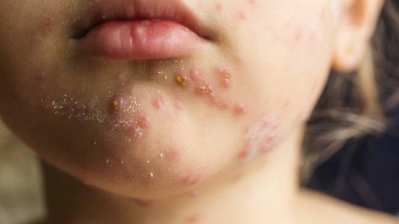 Kızamık salgını: 17 kişi hayatını kaybetti, aşı kampanyası başlatıldı