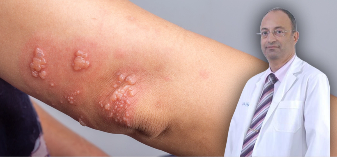 Sessiz kalan virüs yıllar sonra geri dönüyor: Zona tehlikesi